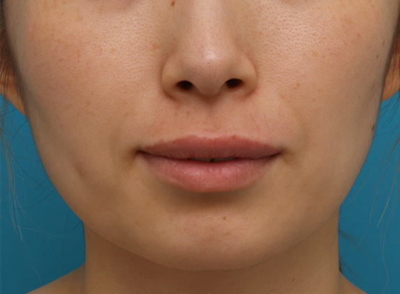 ヒアルロン酸で唇を厚く（ふっくら・アヒル口etc）,ヒアルロン酸注射でアヒル口を作った症例写真,After,ba_atsuku12_a01.jpg