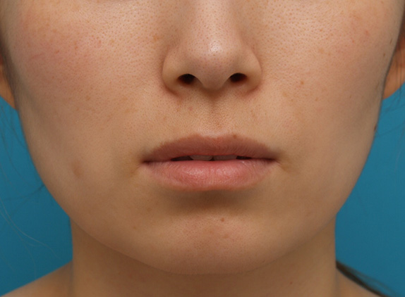 ヒアルロン酸で唇を厚く（ふっくら・アヒル口etc）,ヒアルロン酸注射でアヒル口を作った症例写真,Before,ba_atsuku12_b.jpg