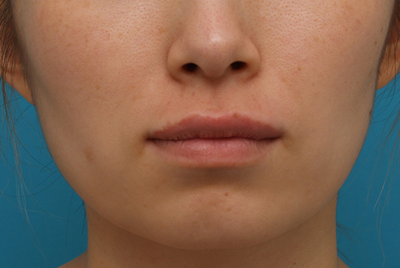 ヒアルロン酸で唇を厚く（ふっくら・アヒル口etc）,ヒアルロン酸注射でアヒル口を作った症例写真,After,ba_atsuku14_b.jpg