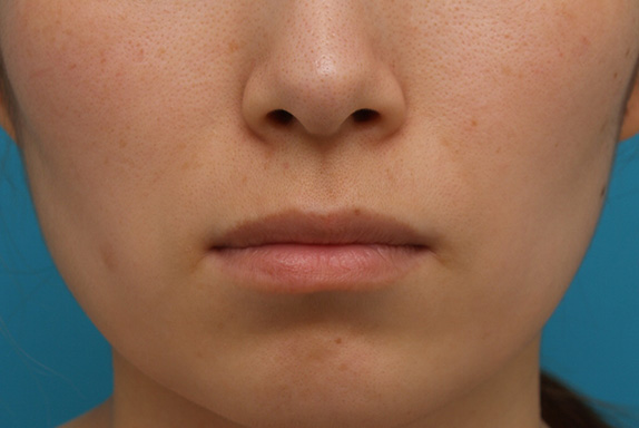 ヒアルロン酸で唇を厚く（ふっくら・アヒル口etc）,ヒアルロン酸注射でアヒル口を作った症例写真,Before,ba_atsuku14_b.jpg