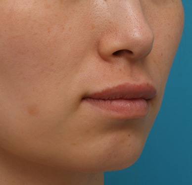 ヒアルロン酸で唇を厚く（ふっくら・アヒル口etc）,ヒアルロン酸注射でアヒル口を作った症例写真,After,ba_atsuku15_b.jpg