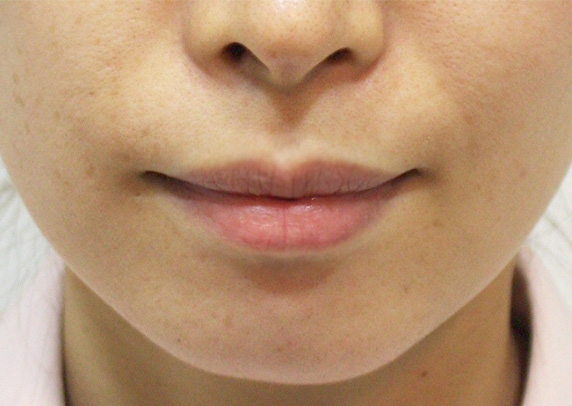 ヒアルロン酸で唇を厚く（ふっくら・アヒル口etc）,唇を厚くした症例写真（ふっくら・アヒル口etc）ヒアルロン酸,After,ba_atsuku07_a01.jpg