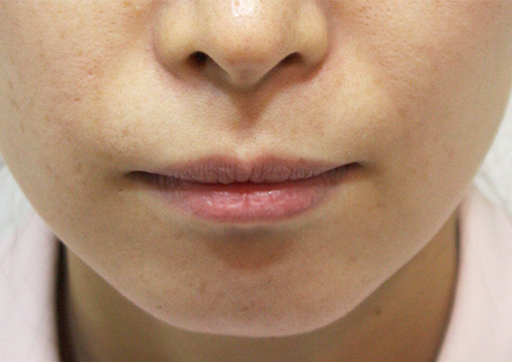 ヒアルロン酸で唇を厚く（ふっくら・アヒル口etc）,唇を厚くした症例写真（ふっくら・アヒル口etc）ヒアルロン酸,Before,ba_atsuku07_b.jpg