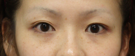 なみだ袋形成（ヒアルロン酸注射）,なみだ袋形成（ヒアルロン酸注射）の症例 淋しい顔立ちを解消したい女性,Before,ba_namida04_b.jpg
