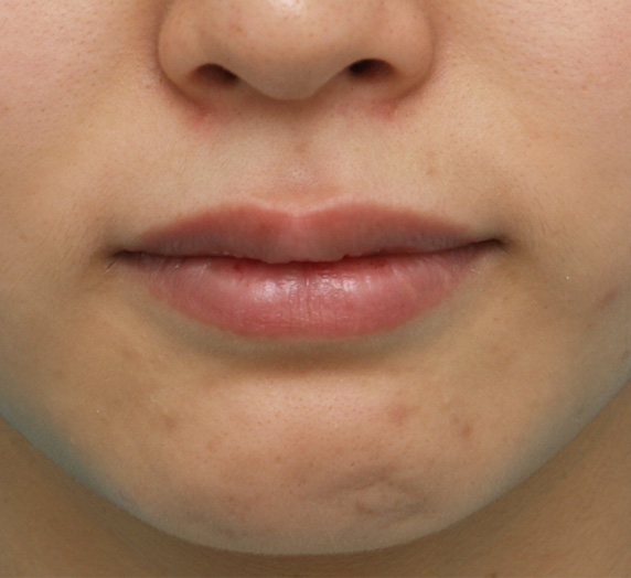 ヒアルロン酸で唇を厚く（ふっくら・アヒル口etc）,上下の唇にヒアルロン酸を注入し、全体的にふっくら厚みのある唇にした症例写真,After,ba_atsuku11_b.jpg
