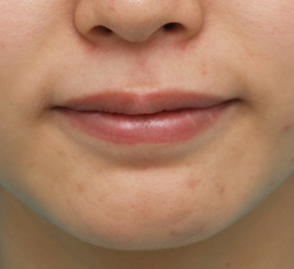 ヒアルロン酸で唇を厚く（ふっくら・アヒル口etc）,上下の唇にヒアルロン酸を注入し、全体的にふっくら厚みのある唇にした症例写真,Before,ba_atsuku11_b.jpg