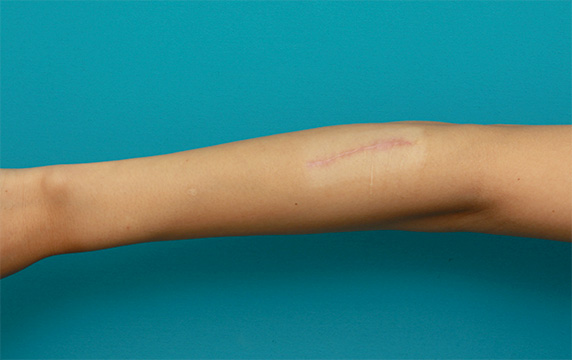 リストカット・根性焼き,傷跡修正の症例写真 腕の根性焼き跡を目立たなくしたい20代女性,After（6ヶ月後）,ba_keisei22_b.jpg