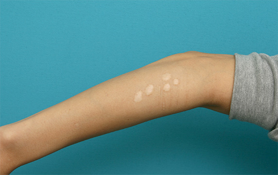 傷跡,傷跡修正の症例写真 腕の根性焼き跡を目立たなくしたい20代女性,Before,ba_keisei22_b.jpg