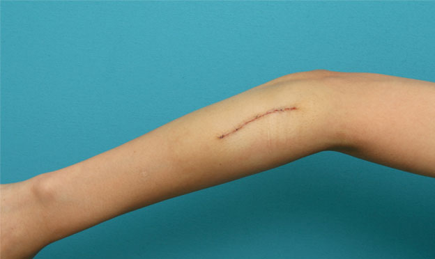 症例写真,傷跡修正の症例写真 腕の根性焼き跡を目立たなくしたい20代女性,手術直後,mainpic_keisei09b.jpg