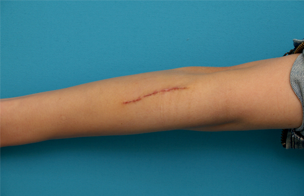 症例写真,傷跡修正の症例写真 腕の根性焼き跡を目立たなくしたい20代女性,1週間後,mainpic_keisei09c.jpg