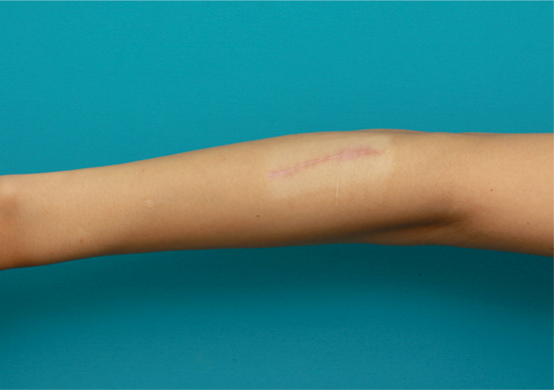 リストカット・根性焼き,傷跡修正の症例写真 腕の根性焼き跡を目立たなくしたい20代女性,6ヶ月後,mainpic_keisei09d.jpg