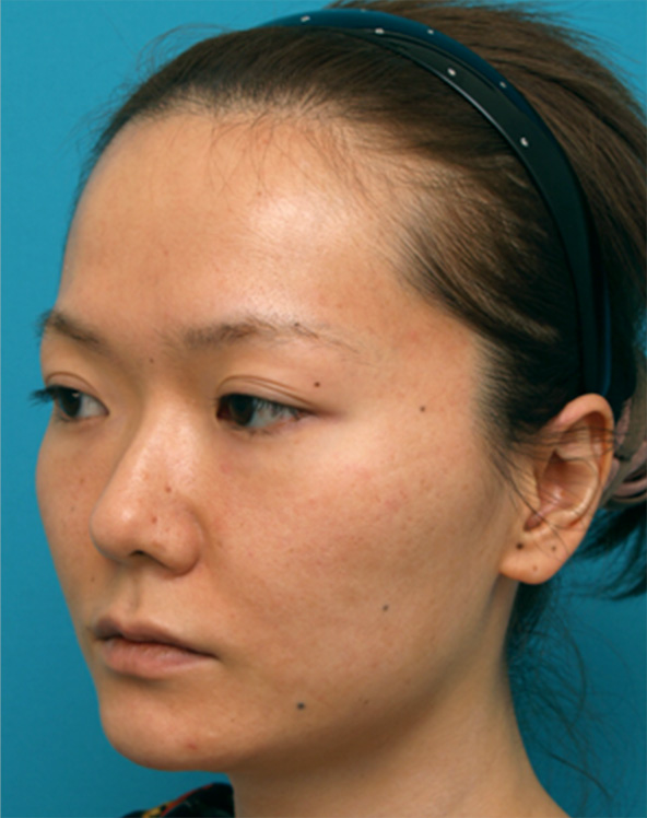なみだ袋形成（ヒアルロン酸注射）,鼻と涙袋のヒアルロン酸注射プチ整形症例写真,Before,ba_namida08_b.jpg