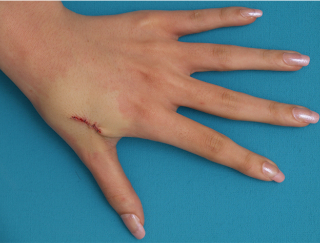 傷跡,手の甲の根性焼きを切除縫縮して1本の傷にした症例写真,手術直後,mainpic_keisei11b.jpg