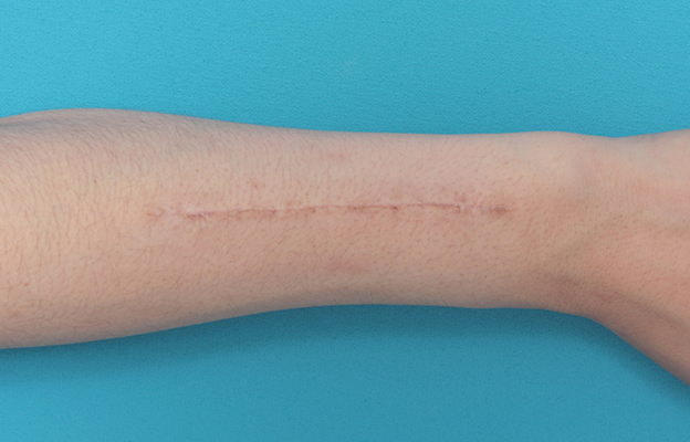 傷跡,傷跡修正の症例 中学生でつけた根性焼きの跡を消したい20代女性,1ヶ月後,mainpic_keisei12c.jpg