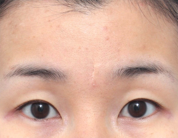 傷跡,眉間の傷跡を切除縫縮手術して目立たなくした症例写真,Before,ba_keisei26_b.jpg