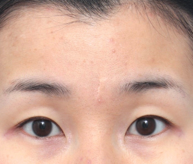 傷跡,眉間の傷跡を切除縫縮手術して目立たなくした症例写真,手術前,mainpic_keisei13a.jpg