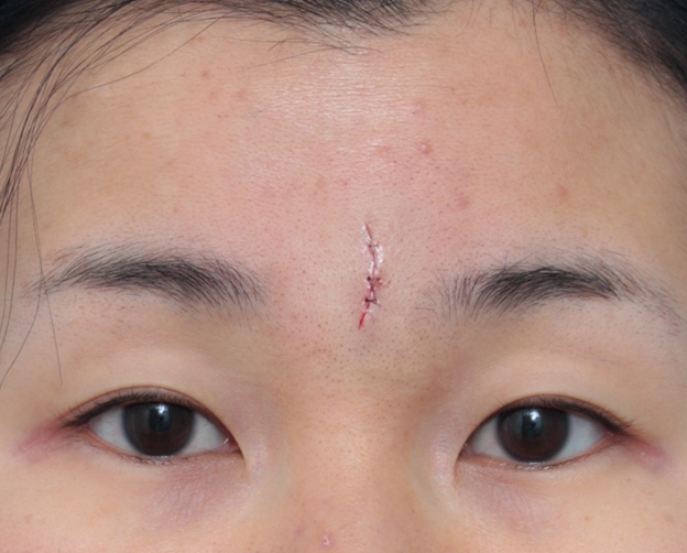 症例写真,眉間の傷跡を切除縫縮手術して目立たなくした症例写真,手術直後,mainpic_keisei13b.jpg