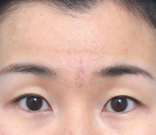 傷跡,眉間の傷跡を切除縫縮手術して目立たなくした症例写真,1週間後の抜糸直後,mainpic_keisei13c.jpg