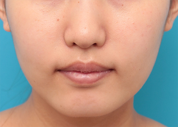 ボツリヌストキシン注射（口角を上げる）,ボツリヌストキシン注射で下がっている口角を自然に上げた20代女性の症例写真,Before,ba_lipsup_botox04_b.jpg