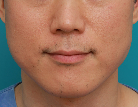 症例写真,ボツリヌストキシン注射で下がった口角を上げた症例写真,After,ba_lipsup_botox01_b.jpg
