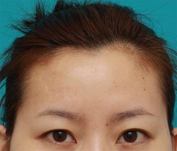 傷跡,額の傷跡を切除縫縮で修正手術した症例写真,After（6ヶ月後）,ba_keisei27_b.jpg