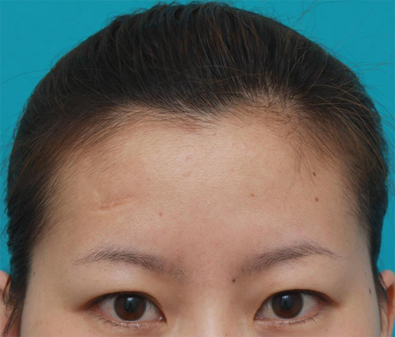 症例写真,額の傷跡を切除縫縮で修正手術した症例写真,Before,ba_keisei27_b.jpg