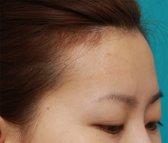 傷跡,額の傷跡を切除縫縮で修正手術した症例写真,After（6ヶ月後）,ba_keisei28_b.jpg