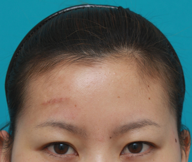 傷跡,額の傷跡を切除縫縮で修正手術した症例写真,1週間後,mainpic_keisei14c.jpg