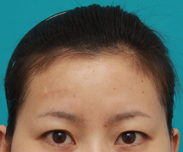 傷跡,額の傷跡を切除縫縮で修正手術した症例写真,1ヶ月後,mainpic_keisei14d.jpg