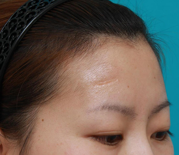 傷跡,額の傷跡を切除縫縮で修正手術した症例写真,手術前,mainpic_keisei14g.jpg