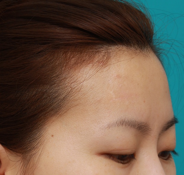 症例写真,額の傷跡を切除縫縮で修正手術した症例写真,6ヶ月後,mainpic_keisei14l.jpg