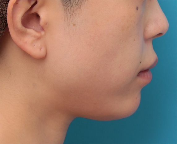あご形成（シリコンプロテーゼ）,顔が長く見えないように顎先をシャープに尖らせるように出した症例写真の術前術後画像,After（6ヶ月後）,ba_ago29_b.jpg
