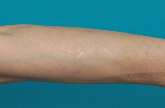 傷跡,リストカットの傷跡を切除縫縮手術して怪我の傷跡のようにした症例写真,After（2年後）,ba_keisei30_b.jpg