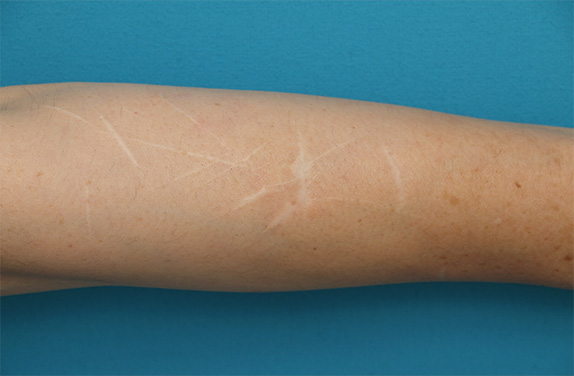 傷跡,リストカットの傷跡を切除縫縮手術して怪我の傷跡のようにした症例写真,Before,ba_keisei30_b.jpg