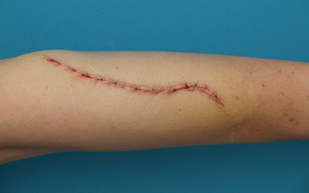 傷跡,リストカットの傷跡を切除縫縮手術して怪我の傷跡のようにした症例写真,手術直後,mainpic_keisei16b.jpg