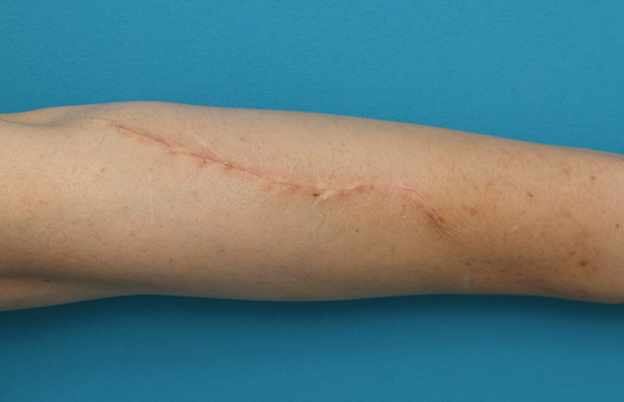 リストカット・根性焼き,リストカットの傷跡を切除縫縮手術して怪我の傷跡のようにした症例写真,1週間後,mainpic_keisei16c.jpg