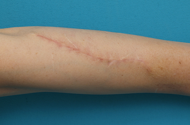 傷跡,リストカットの傷跡を切除縫縮手術して怪我の傷跡のようにした症例写真,1ヶ月後,mainpic_keisei16d.jpg