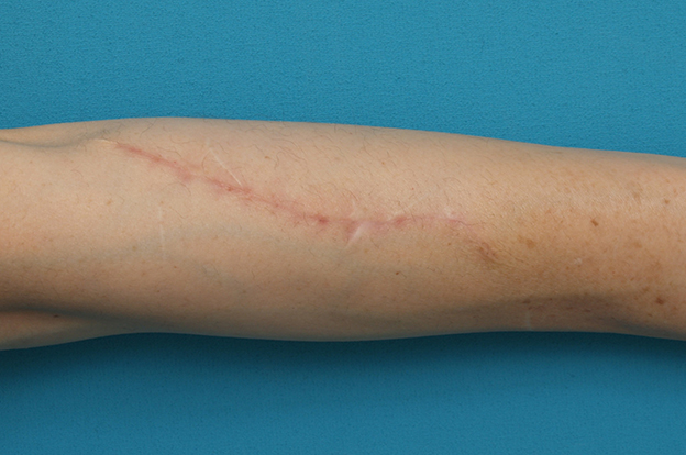 傷跡,リストカットの傷跡を切除縫縮手術して怪我の傷跡のようにした症例写真,3ヶ月後,mainpic_keisei16e.jpg
