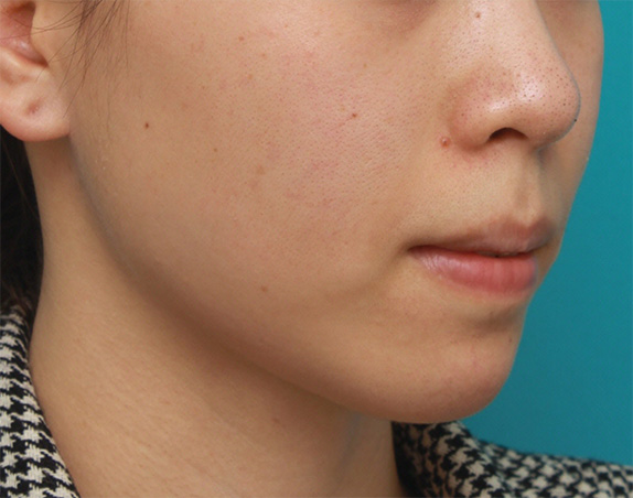 症例写真,口元が出て顎が引っ込んでいる女性に顎シリコンプロテーゼを入れて顎を出した症例写真,After（6ヶ月後）,ba_ago25_b.jpg