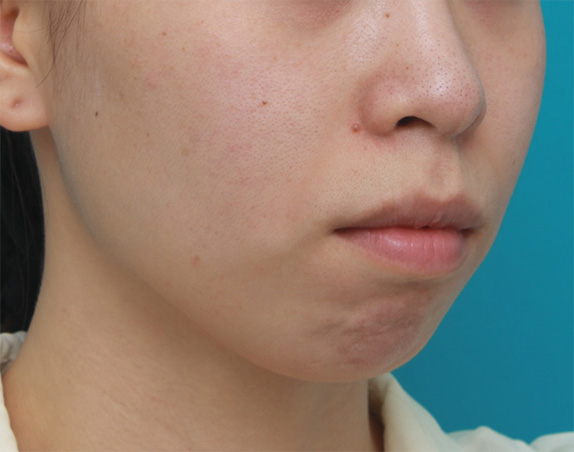 あご形成（シリコンプロテーゼ）,口元が出て顎が引っ込んでいる女性に顎シリコンプロテーゼを入れて顎を出した症例写真,Before,ba_ago25_b.jpg