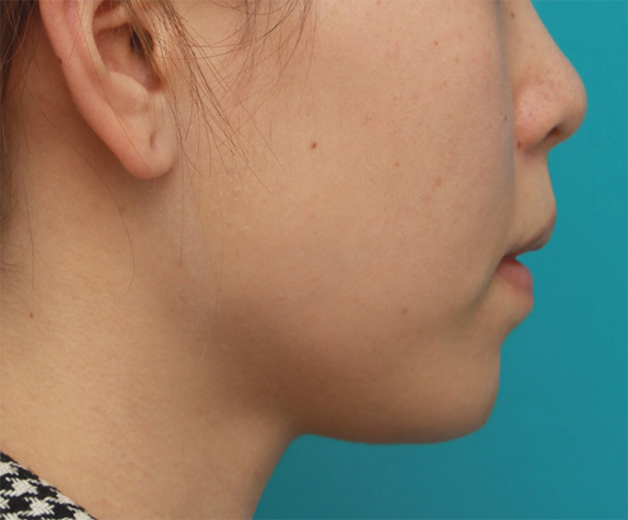 あご形成（シリコンプロテーゼ）,口元が出て顎が引っ込んでいる女性に顎シリコンプロテーゼを入れて顎を出した症例写真,After（6ヶ月後）,ba_ago26_b.jpg