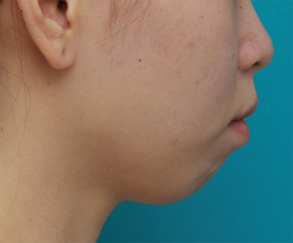 あご形成（シリコンプロテーゼ）,口元が出て顎が引っ込んでいる女性に顎シリコンプロテーゼを入れて顎を出した症例写真,Before,ba_ago26_b.jpg