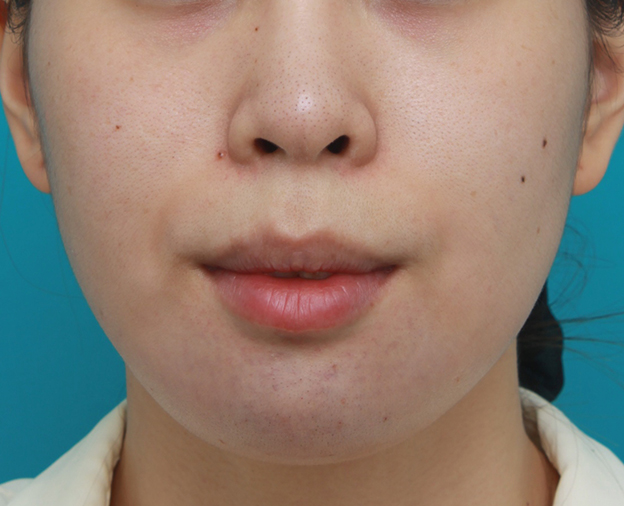 あご形成（シリコンプロテーゼ）,口元が出て顎が引っ込んでいる女性に顎シリコンプロテーゼを入れて顎を出した症例写真,手術直後,mainpic_ago03b.jpg