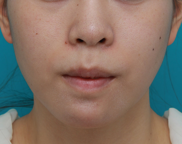 あご形成（シリコンプロテーゼ）,口元が出て顎が引っ込んでいる女性に顎シリコンプロテーゼを入れて顎を出した症例写真,10日後,mainpic_ago03c.jpg