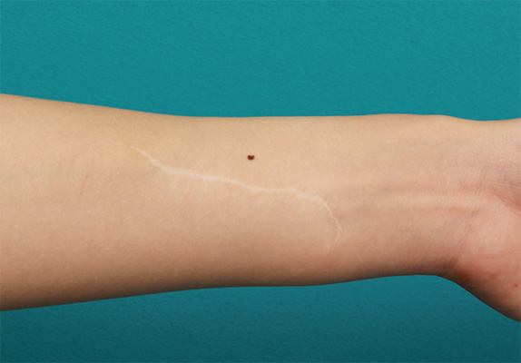 傷跡,リストカットの傷跡を2回に分けて完全に切除縫縮した症例写真,After（2回目手術後2年6ヶ月）,ba_keisei31_b.jpg