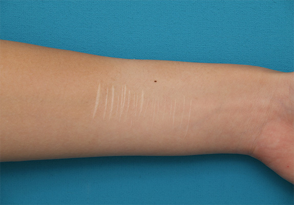 リストカット・根性焼き,リストカットの傷跡を2回に分けて完全に切除縫縮した症例写真,Before,ba_keisei31_b.jpg