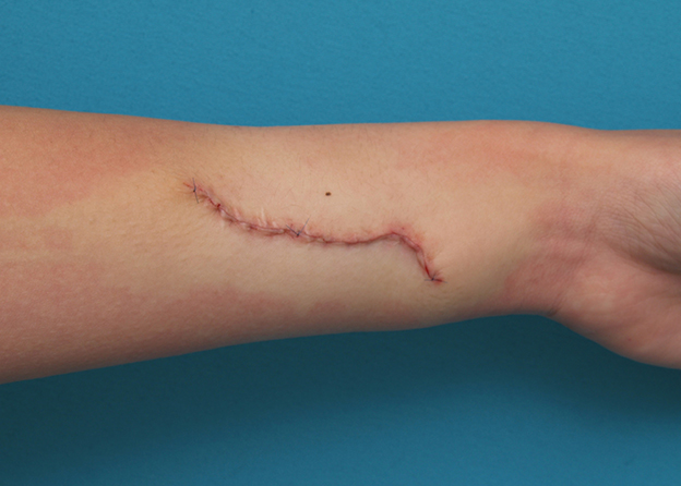 リストカット・根性焼き,リストカットの傷跡を2回に分けて完全に切除縫縮した症例写真,1回目手術直後,mainpic_keisei17b.jpg