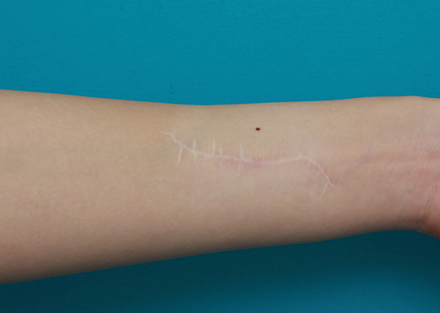 リストカット・根性焼き,リストカットの傷跡を2回に分けて完全に切除縫縮した症例写真,1回目手術後1年,mainpic_keisei17d.jpg