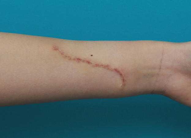 症例写真,リストカットの傷跡を2回に分けて完全に切除縫縮した症例写真,2回目手術後1週間,mainpic_keisei17f.jpg