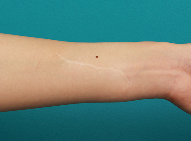 リストカット・根性焼き,リストカットの傷跡を2回に分けて完全に切除縫縮した症例写真,2回目手術後2年6ヶ月,mainpic_keisei17g.jpg